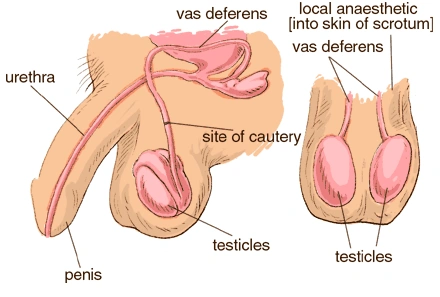 vasectomy diagram